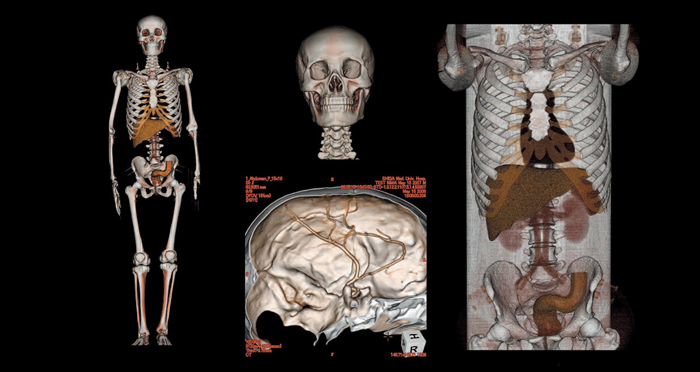 日本KYOTO KAGAKU CT全身模型,PBU-60全身模体